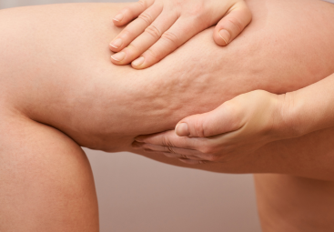 Celulitis: medicina occidental, china y Ayurveda